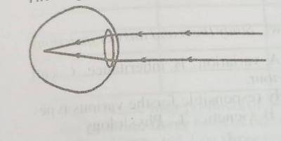 The eye defect can be corrected by the use of
